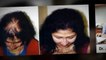 baldness - female hair loss - fue hair transplant - Dr. Ari Arumugam - Hari Loss Treatment Chennai - Dr. Ari Chennai