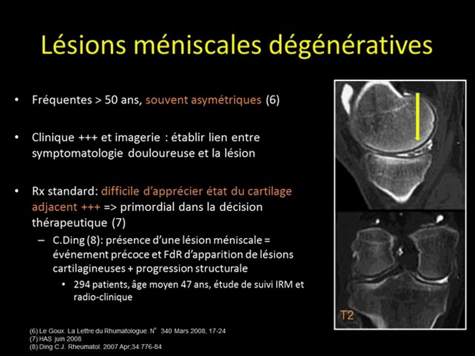 Douleurs du genou dans la gonarthrose_corrélation clinique_IRM