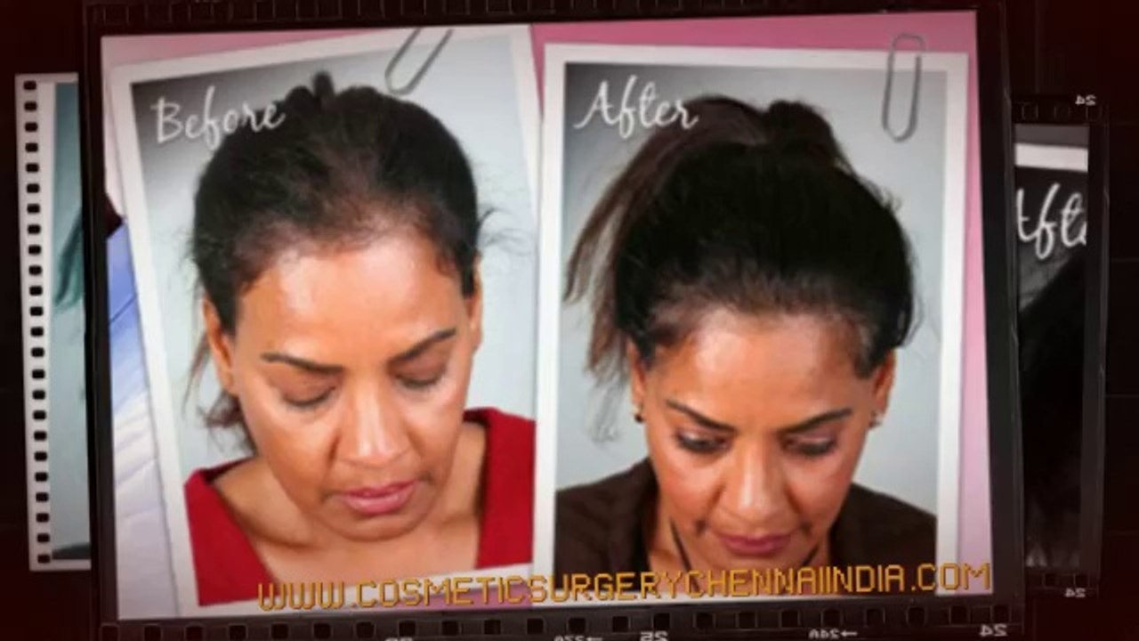 male pattern baldness - natural hair growth - ovation hair - Dr. Ari Chennai - Dr. Ari Arumugam - Hari Loss Treatment Chennai