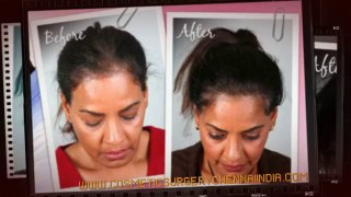 hair restoration - hair spa - hair thinning - Dr. Ari Chennai - Dr. Ari Arumugam - Plastic Surgery Chennai