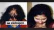 hair loss women - hair plugs - hair regrowth - Dr. Ari Arumugam - Plastic Surgery Chennai - Dr. Ari Chennai