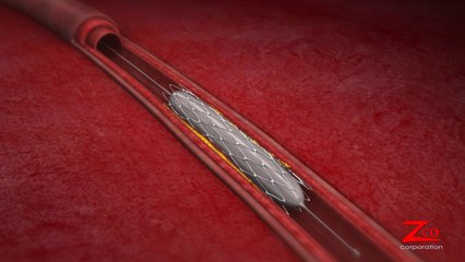 3D Angioplasty Medical Video Production by Zco