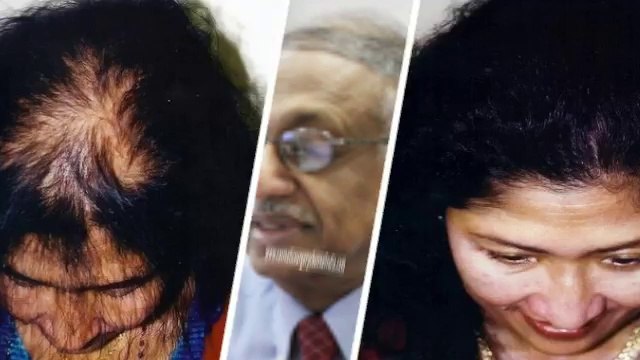 hair spa - hair thinning - hair transplant - Hari Loss Treatment Chennai - Dr. Ari Chennai - Dr. Ari Arumugam