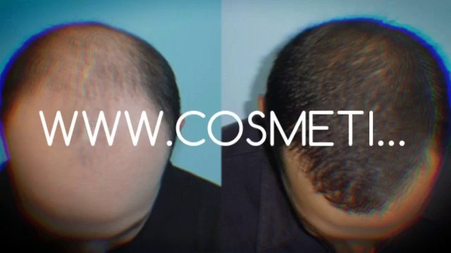 hairloss - home remedies for hair growth - how to grow hair - Dr. Ari Arumugam - Hari Transplant Chennai - Dr. Ari Chennai