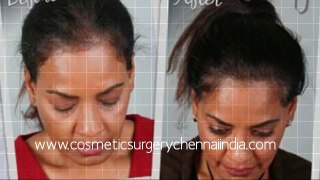 how to stop hair fall - how to stop hair loss - laser comb - Dr. Ari Chennai - Dr. Ari Arumugam - Hari Transplant Chennai