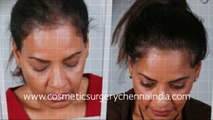 how to stop hair loss - laser comb - male pattern baldness - Cosmetic Surgery Chennai - Dr. Ari Chennai - Dr. Ari Arumugam