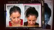 hair loss causes - hair loss in women - hair loss shampoo - Dr. Ari Arumugam - Hari Transplant Chennai - Dr. Ari Chennai