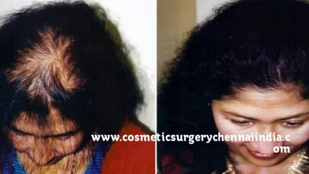 hair loss in women - hair loss shampoo - hair loss treatment - Dr. Ari Chennai - Dr. Ari Arumugam - Cosmetic Surgery Chennai