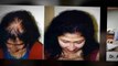 hair implants - hair loss - hair loss causes - Dr. Ari Arumugam - hair Transplant Chennai - Dr. Ari Chennai