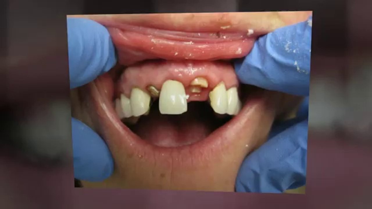 Cosmetic Dentist Frisco TX  972-335-7666