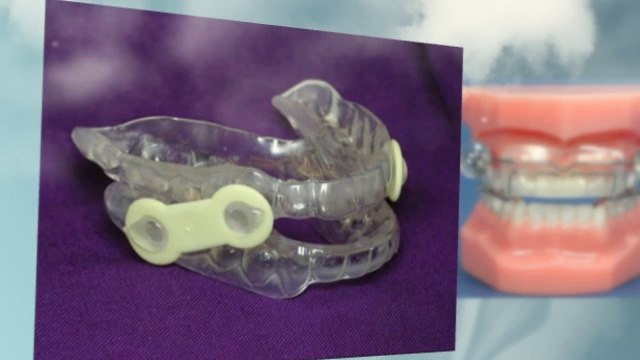 Apnea Dental Appliance | Sleep Apnea Dental Appliance