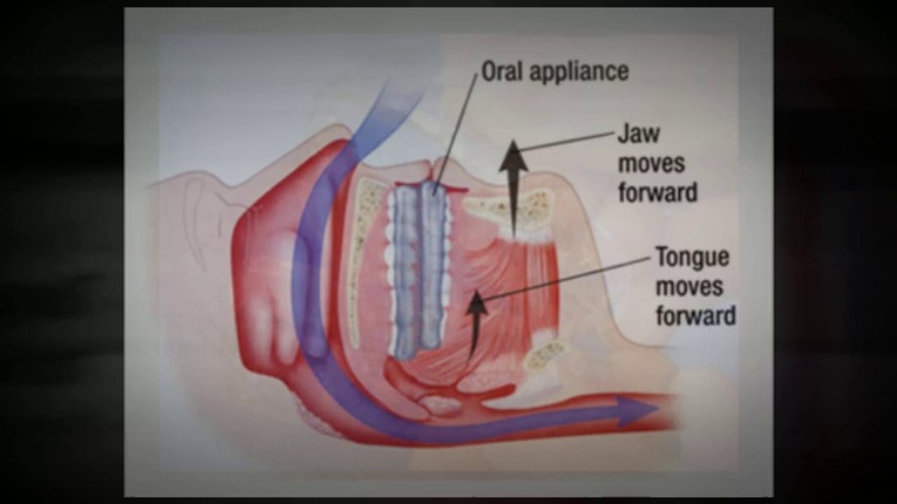Dental Appliance For Sleep Apnea | Dental Appliance Sleep Apnea
