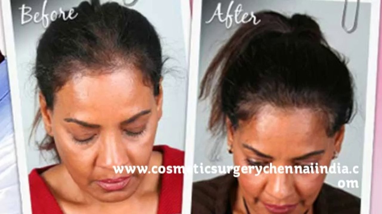 ovation hair - regrow hair - scalp med - Dr. Ari Chennai - Dr. Ari Arumugam - Cosmetic Surgery Chennai