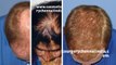 scalp med - shampoo for hair loss - thinning hair - Dr. Ari Chennai - Dr. Ari Arumugam - hair Loss Treatment Chennai