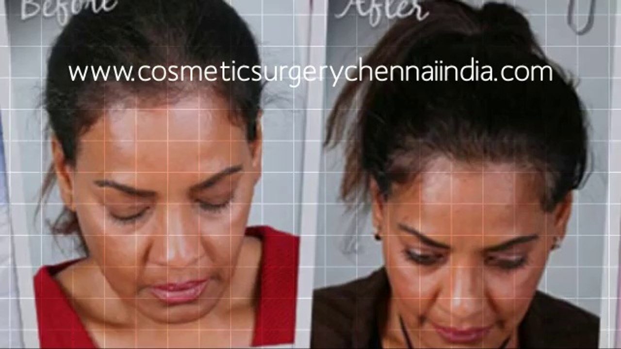 hair loss women - hair plugs - hair regrowth - hair Transplant Chennai - Dr. Ari Chennai - Dr. Ari Arumugam