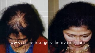 hair plugs - hair regrowth - hair replacement - Dr. Ari Arumugam - Cosmetic Surgery Chennai - Dr. Ari Chennai