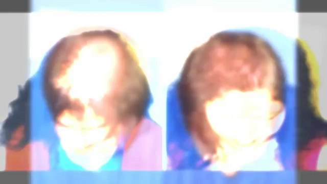 hair fall - hair fall solution - hair fall treatment - Dr. Ari Arumugam - Plastic Surgery Chennai - Dr. Ari Chennai