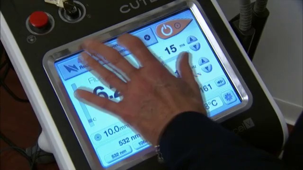 Cutera Excel V  Brandt 1