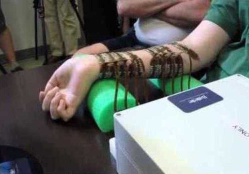 Paralyzed Man Moves Hand Using Neurobridge Technology