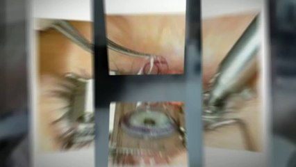 Bladeless Lasik