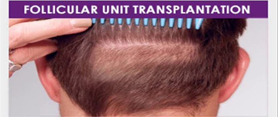 Hair Transplant in Dubai | Hair Transplantation in Dubai