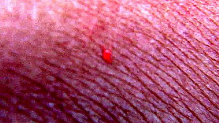 Flesh Eating Bug Ate my Skin - Bizarre Bloodcurdling attack-
