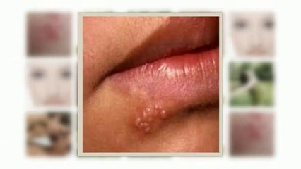 The Ultimate Herpes Protocol Review