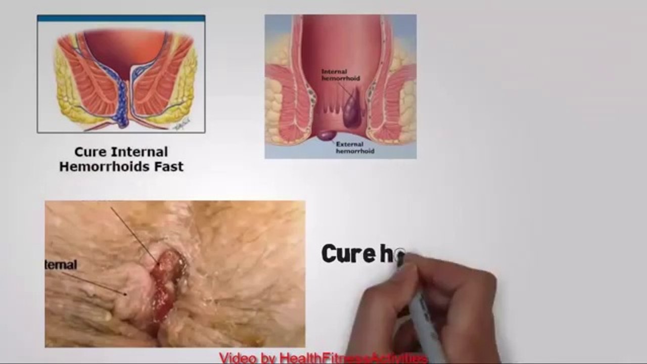 Hemorrhoids Home Treatment - How to Cure Hemorrhoids in 48 Hours