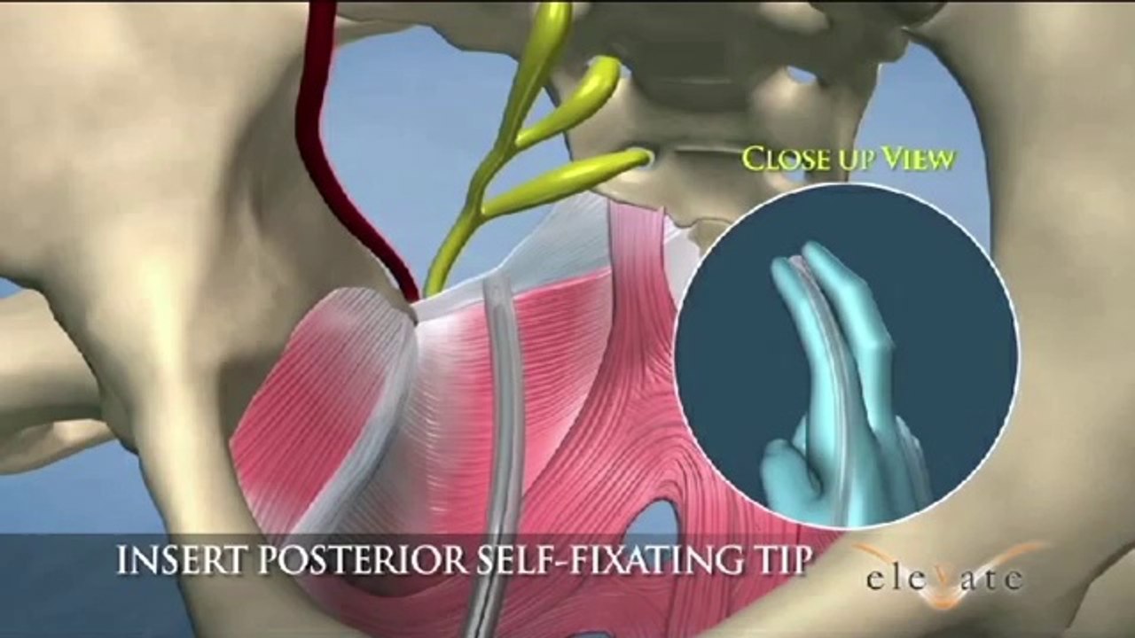 AMS Elevate PC Posterior - Animation