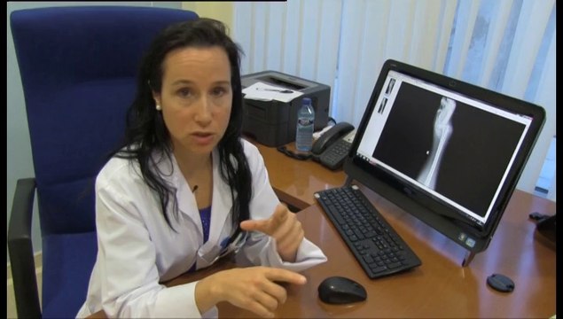 La artritis reumatoide en las manos de mujer