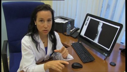 La artritis reumatoide en las manos de mujer