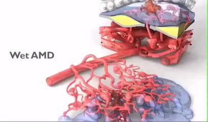 What is Age-Related Macular Degeneration?