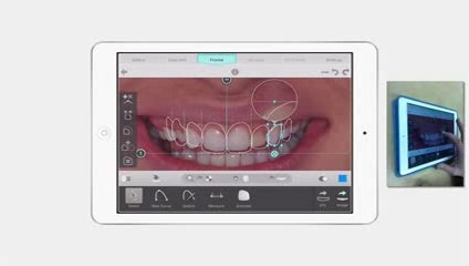 Smile Designer Pro pour tablettes iPad, une simulation de cas esthétique en 4 minutes
