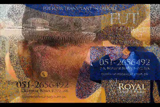 FUT Hair Transplant in Pakistan | FUT Hair Transplant in Islamabad | FUT Hair Transplant in Lahore