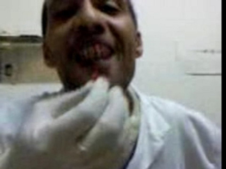 Suite de l arrachage de dents