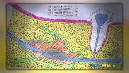 TRULY HEAL / DENTAL CAVITATIONS