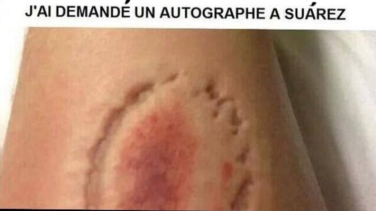 Une morsure de Suárez en guise d'autographe !
