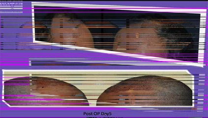 Hair Transplantation in Dubai