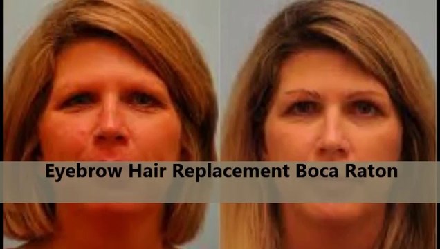 Dr. Glenn M. Charles, DO Best Eyebrow Transplant Surgeon in Boca Raton