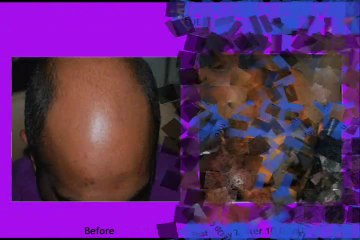 Hair Transplant Cost in Dubai