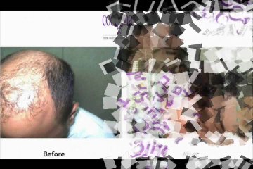 FUE Hair Transplant Clinic Dubai