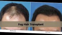 Dr. Glenn M. Charles, DO Best Surgeon Follicular Unit Hair Transplants