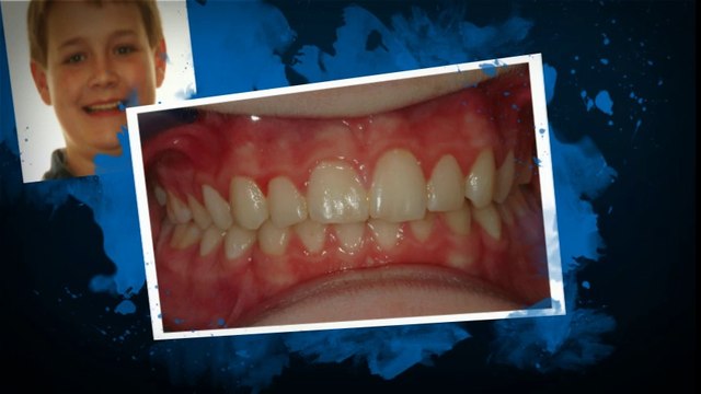 Littleton Braces June2014