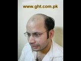 Best FUE Hair Transplant Clinic and Doctor in Pakistan - www.fuepakistan.com