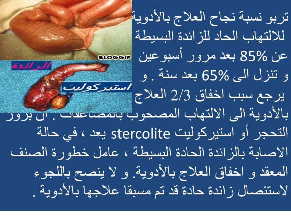 APPENDICITE,appendicectomie,traitement,diagnosic,chirurgie et médicaments