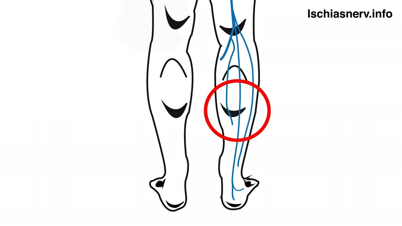 Protrusion, ischiasnerv