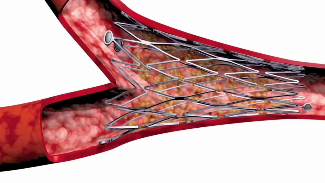 Cardiac Catheterization and Stenting in Houston, Valvular Disease, Valvular Disease Doctor, Diagnostic Tests in Houston, Signs of Heart Disease