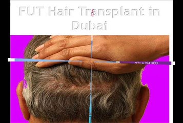 Crown Hair Transplant in Dubai
