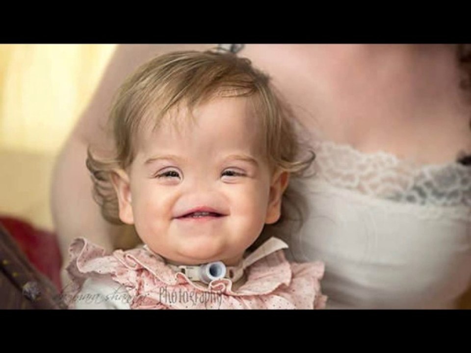 Cette petite fille est née sans nez en Irlande