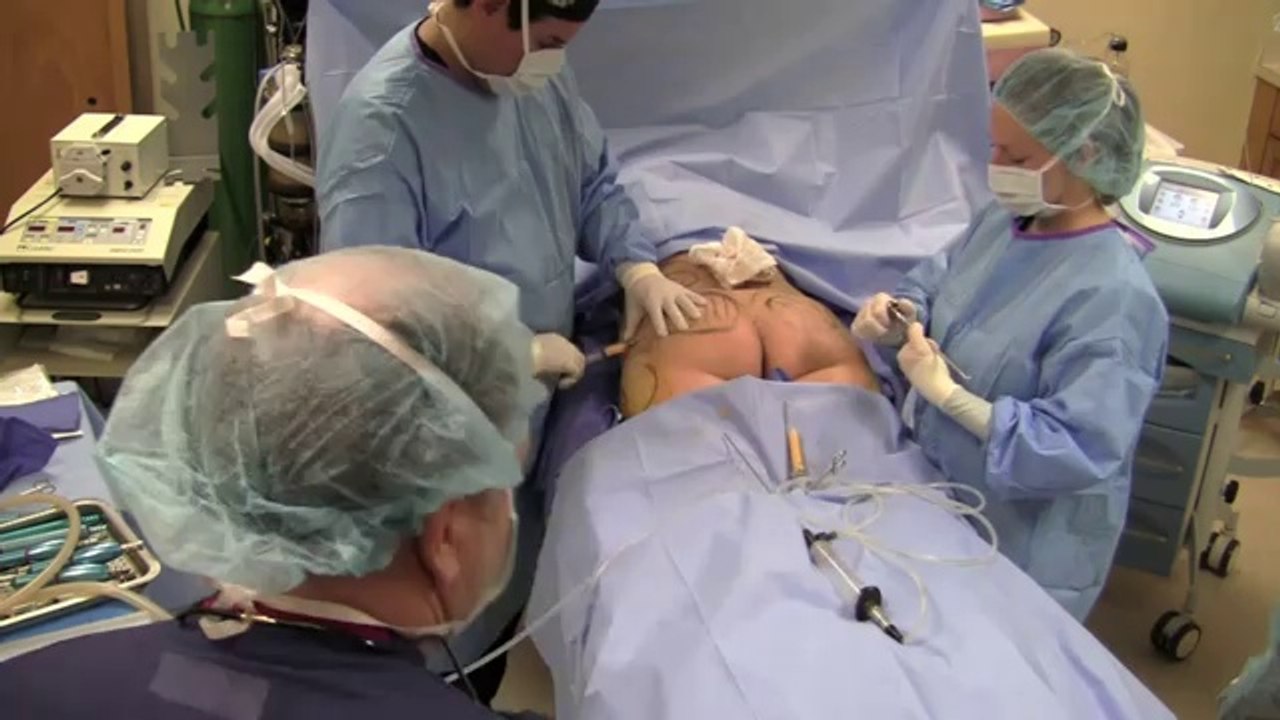 Liposuction in Plano, TX